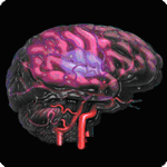 Accidente derebrovascular