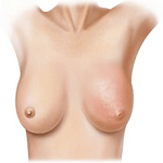 Prevención del cancer de mama